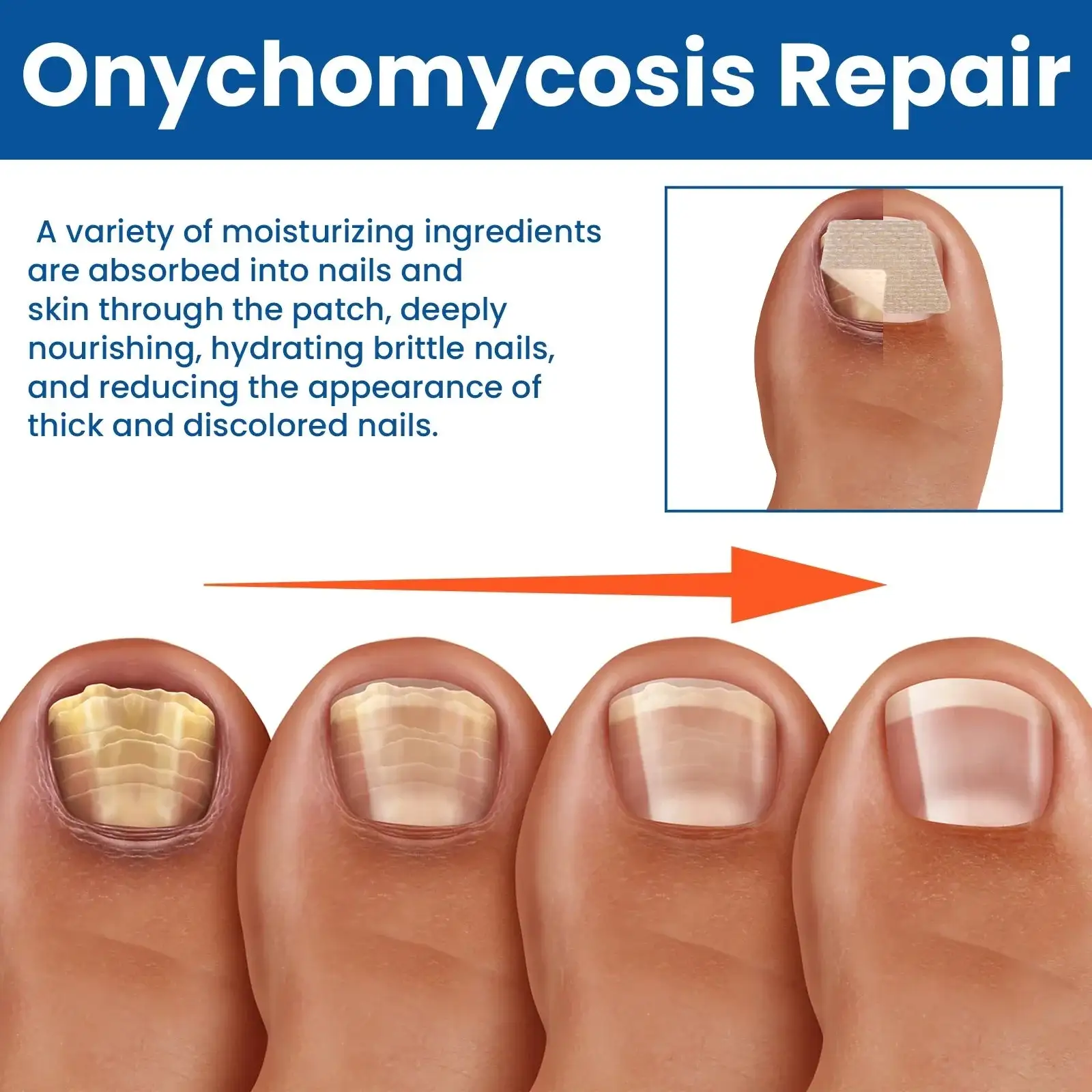 Reparatiepleisters voor schimmelnagels - Afbeelding 4